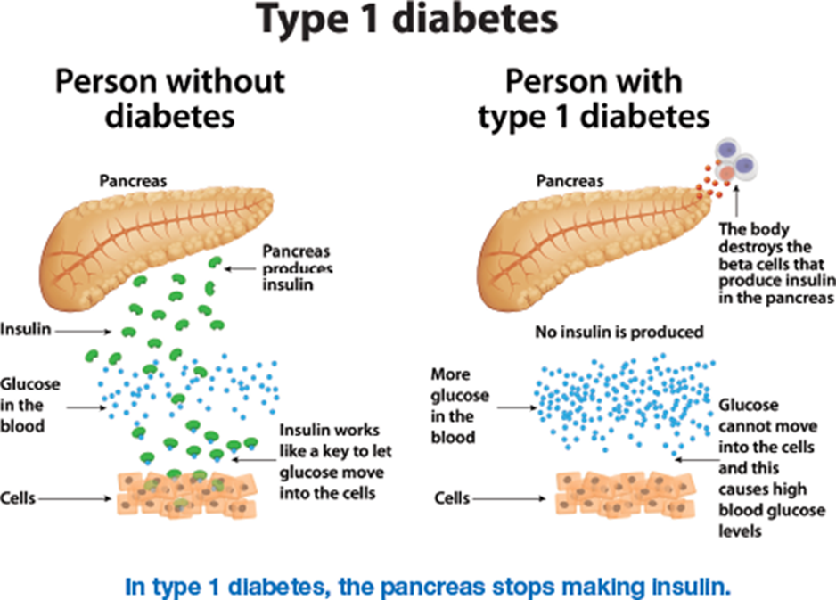 Diagram of how Type 1 Diabetes affects the pancreas