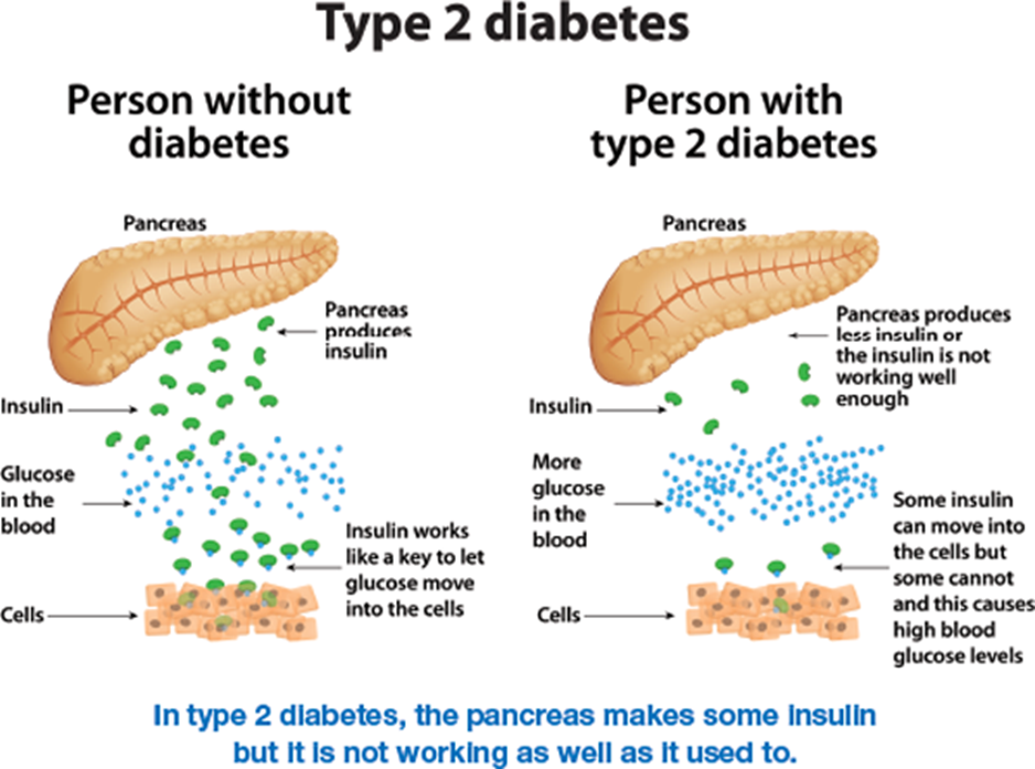 Diagram depicting what happens to the pancreas with Type 2 diabetes