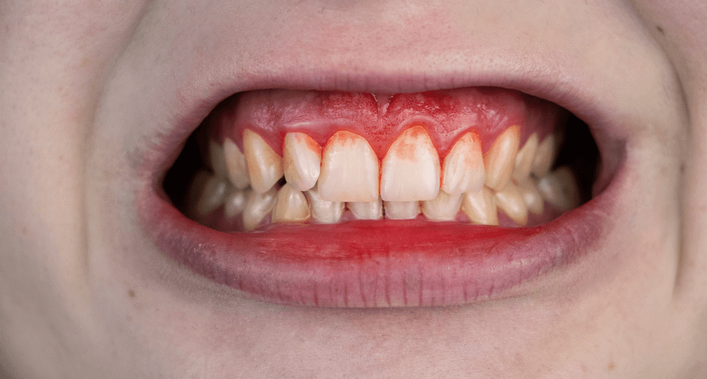 Dental Health Blog Poor Oral Hygiene Hero Banner