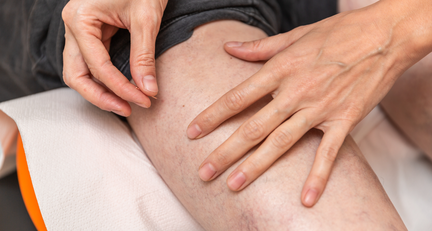 Dry Needling Hero Banner