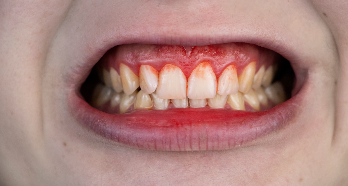 Poor Oral Hygiene