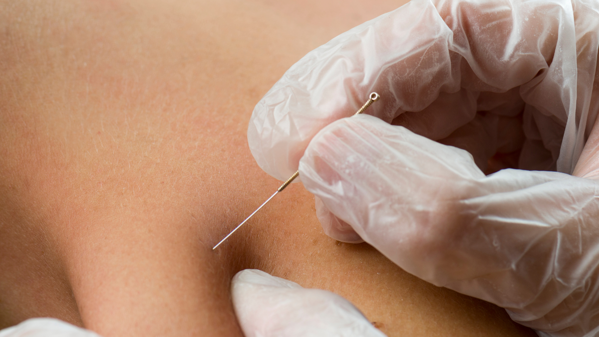 a dry needle is inserted to skin by a gloved hand