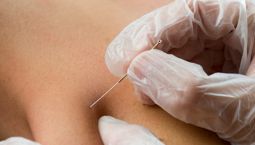Thumbnail: Dry Needling vs Acupuncture - What is the Difference?
